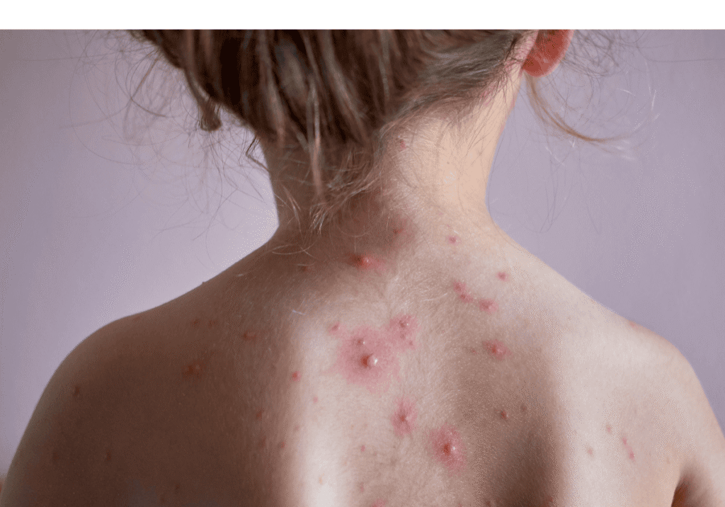 Child with chickenpox spots on their back