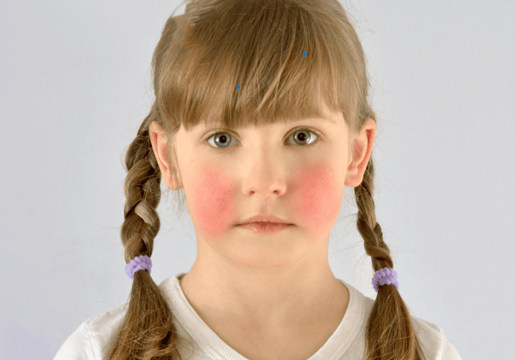 Child with bright red cheeks